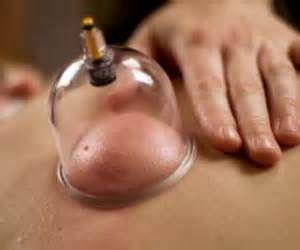Cupping met een glazen cup op de rug